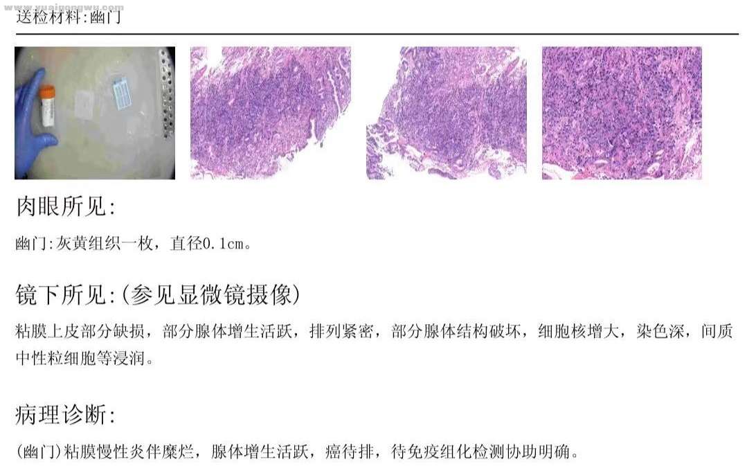 幽门慢性炎伴糜烂待免疫组化